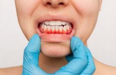 Boli care pot duce la pierderea dinților