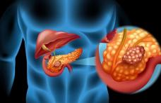 Molecula care distruge cancerul pancreatic